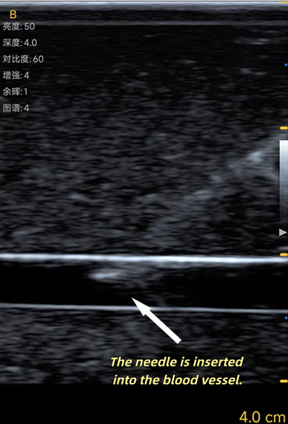Ultrasound Vascular Puncture T - Medical Gel Ultrasound ulasan dan harga